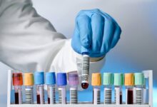 ارتفاع هرمون الأنوثة و8 أعراض عند الرجال 8 ارتفاع هرمون الأنوثة